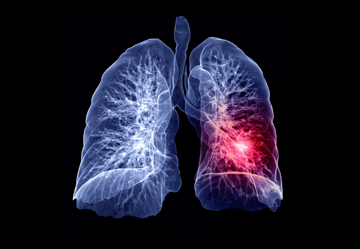 Study Demonstrates Anti-Aging Therapy for Pulmonary Fibrosis