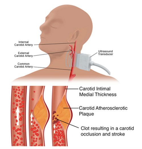 The top image diagrams the main artery in the neck with a device next to it. The bottom image shows a plaque building up in the artery until it is clogged. 