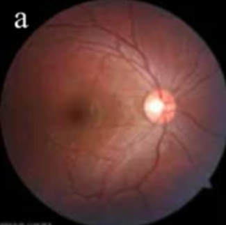 Images of the eye's retina are used in AI-based assessments that predict age-related diseases.