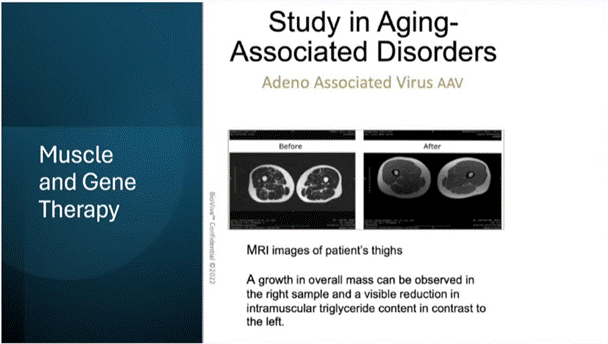Liz Parrish underwent follistatin gene therapy, which increased lean muscle mass in her thighs compared to before the treatment.