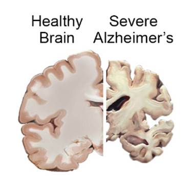 An image of a healthy brain hemisphere (left) and one with severe Alzheimer's (right)