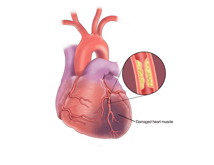 Coronary heart disease involves narrowed or blocked arteries that supply blood to the heart muscle and often entails a damaged heart muscle.