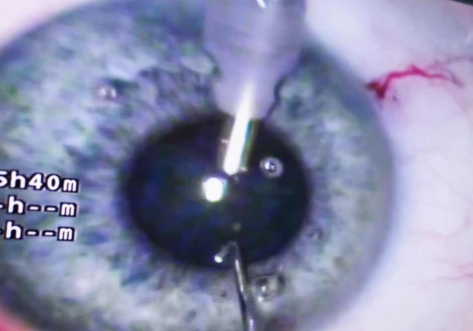 An image of an ER-100 gene therapy injection into an eye
