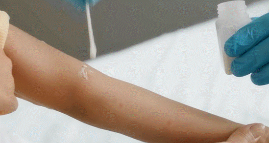 A photo of a clinician applying RLS-1496 to a person's skin